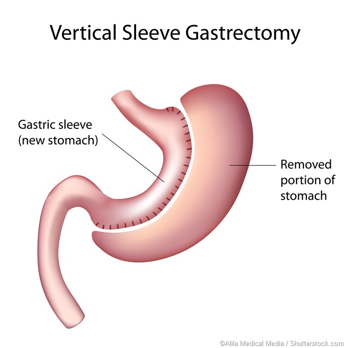 sleeve gastroplast